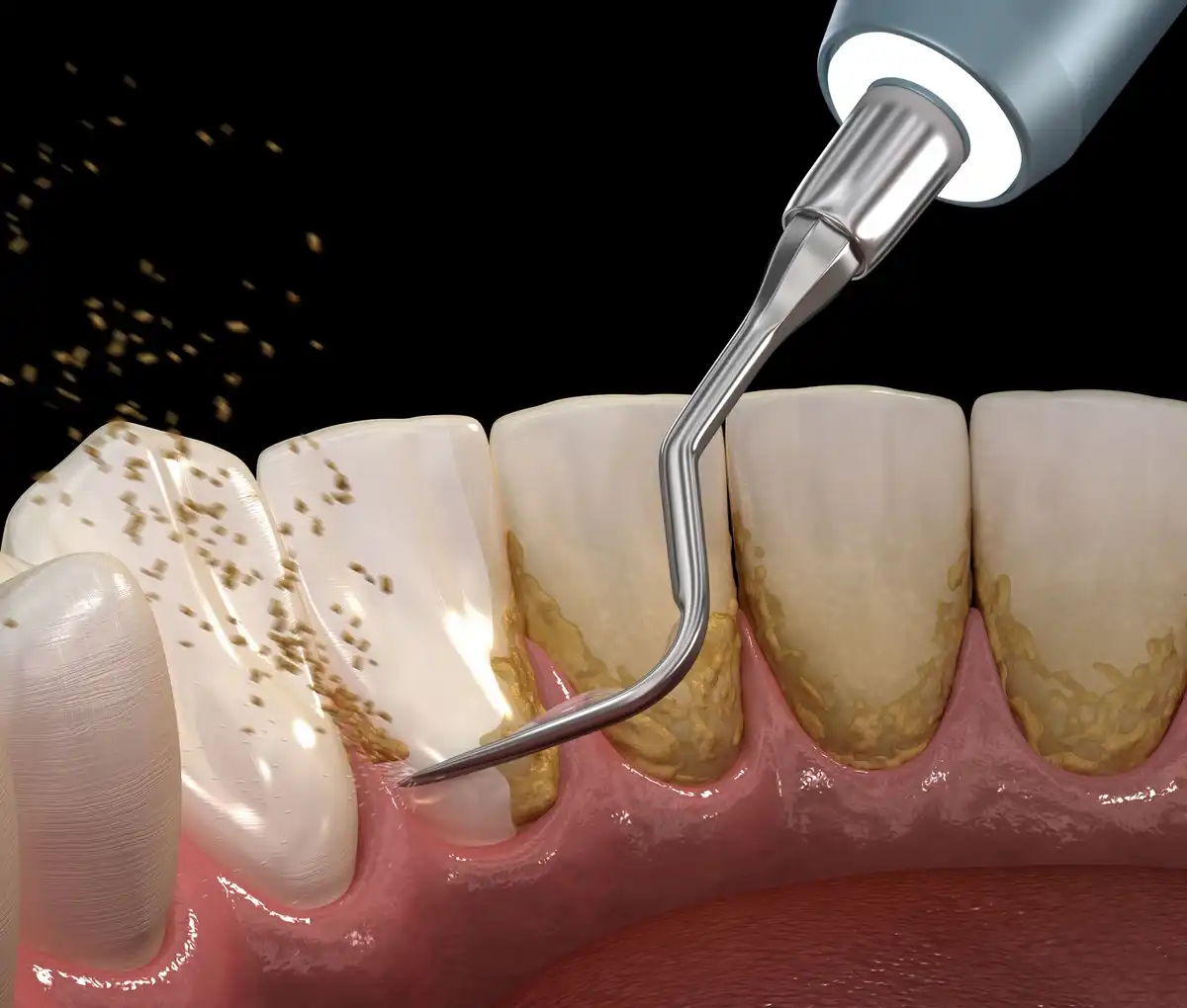 Remove Plaque From Your Teeth Just In 2 Minutes!